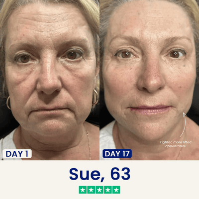 The Medilysa™ Lift : Say goodbye to your double chin now