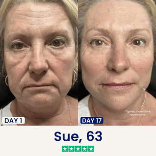 The Medilysa™ Lift : Say goodbye to your double chin now