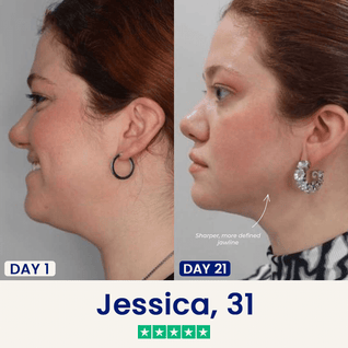 The Medilysa™ Lift : Say goodbye to your double chin now