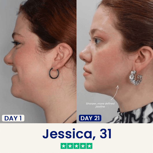 The Medilysa™ Lift : Say goodbye to your double chin now