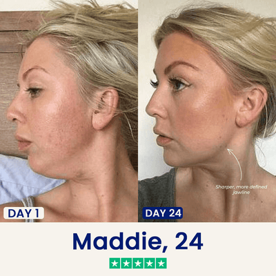 The Medilysa™ Lift : Say goodbye to your double chin now